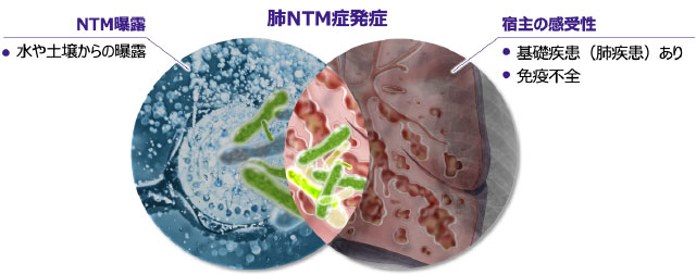 肺NTM症の発症：NTM曝露と宿主側の要因