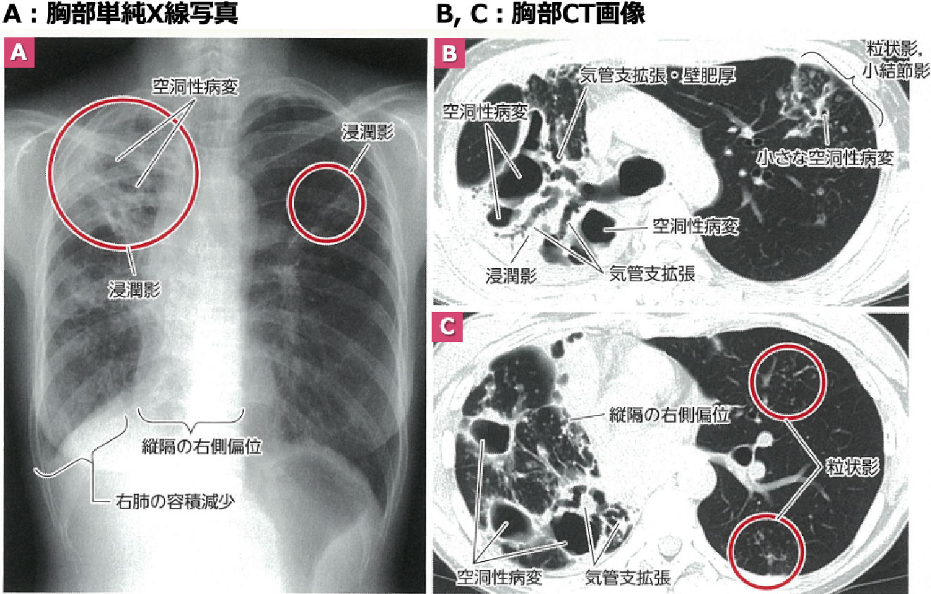 検査する｜NTM navi NTM症（非結核性抗酸菌症）に関する情報サイト